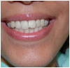 Braces Inside